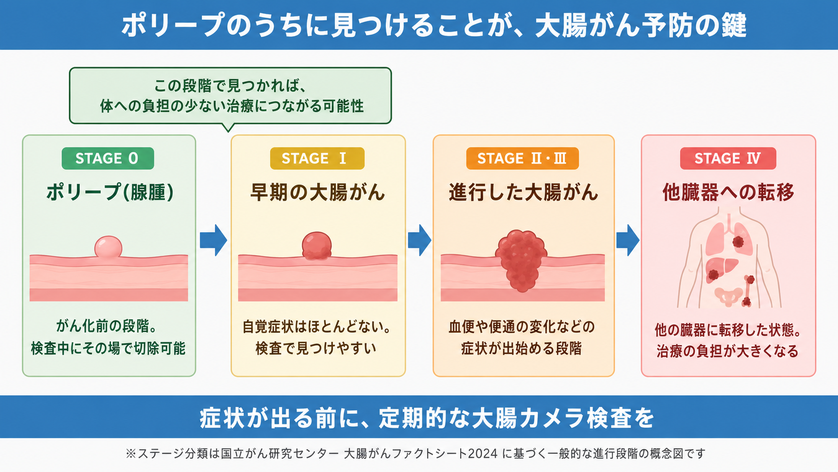 ポリープ（腺腫）からステージ0・Ⅰ・Ⅱ/Ⅲ・Ⅳへと進行する大腸がんの段階を示した概念図